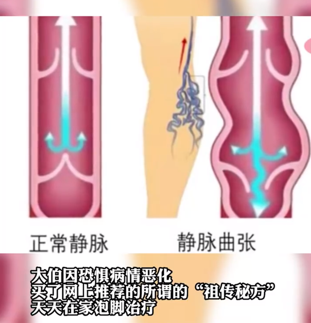 最新静脉曲张治疗方法揭秘，30日重塑健康双腿，告别疼痛困扰！