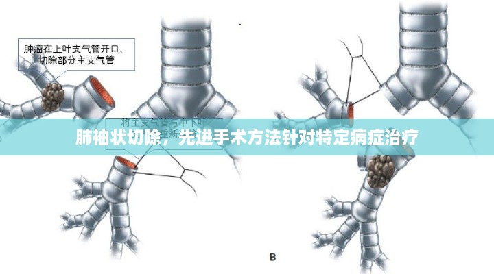 肺袖状切除，先进手术方法针对特定病症治疗