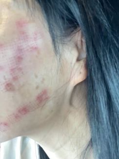 女生美容院拔罐后变紫薯精，拔罐——传统美容新体验